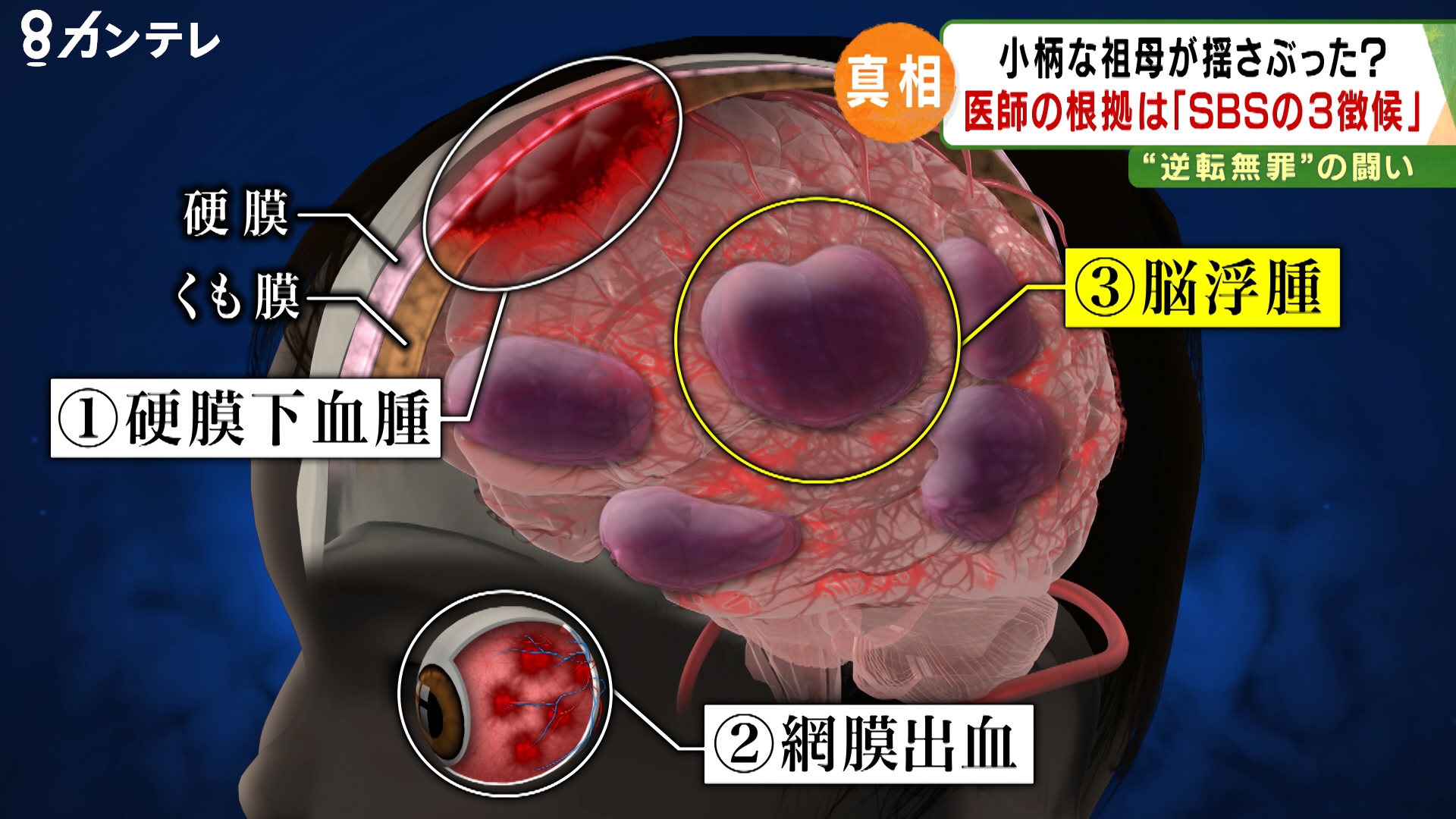 SBS（揺さぶられっ子症候群）特集